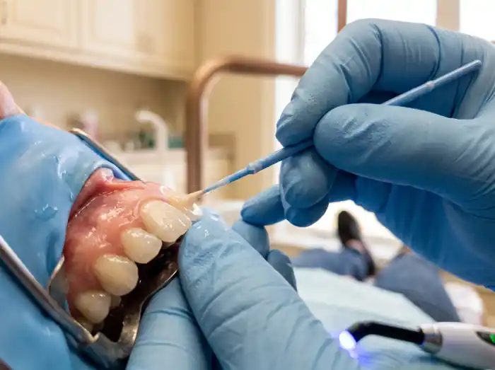 Composite being shaped along the biting edge of a front tooth