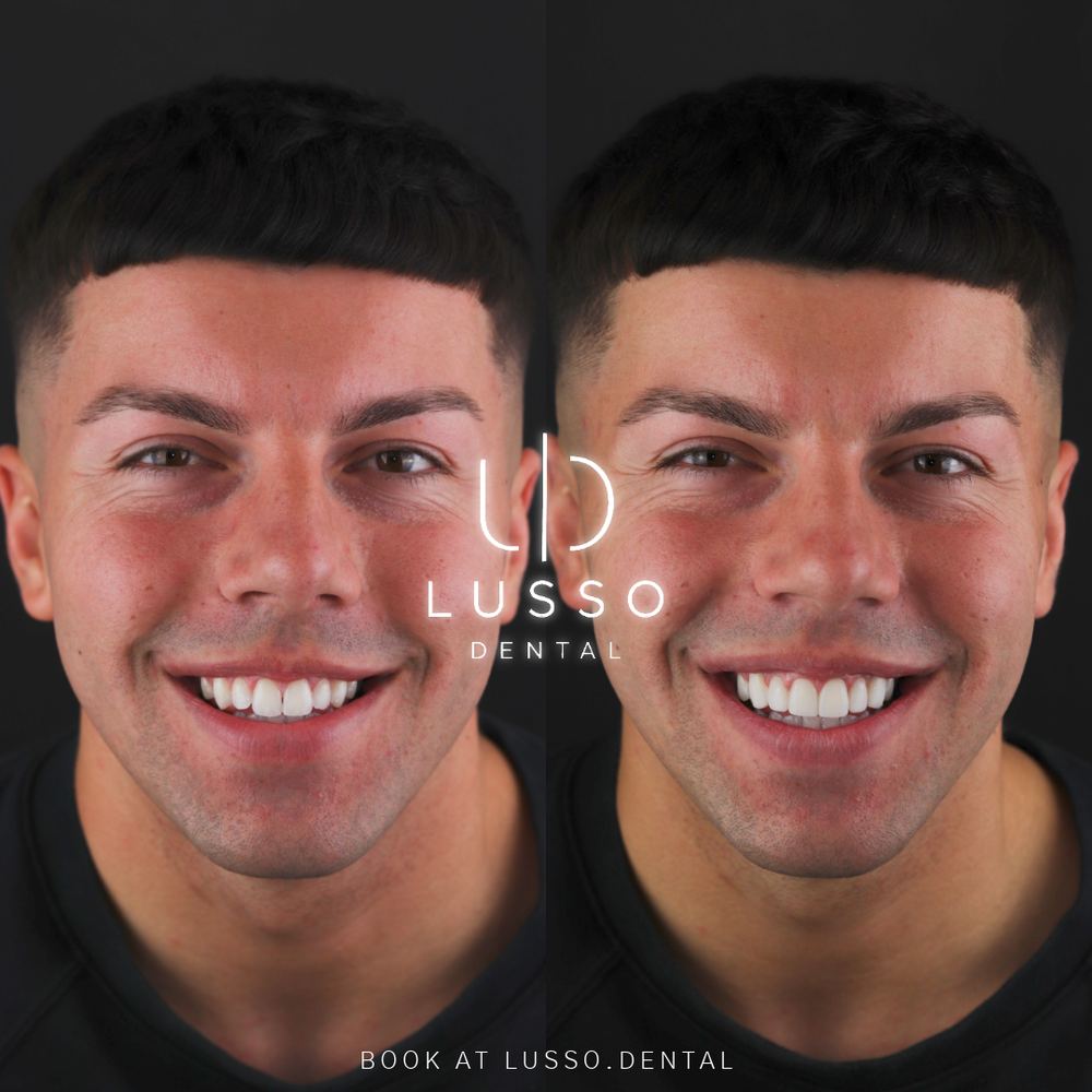 Clear aligners, before and after case 1 of 12, Dr Kal's own work