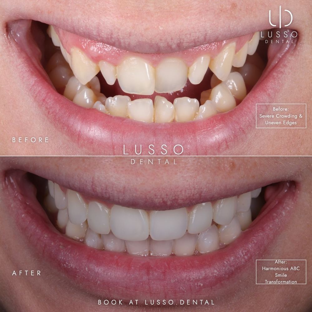 Clear aligners, before and after case 2 of 12, Dr Kal's own work