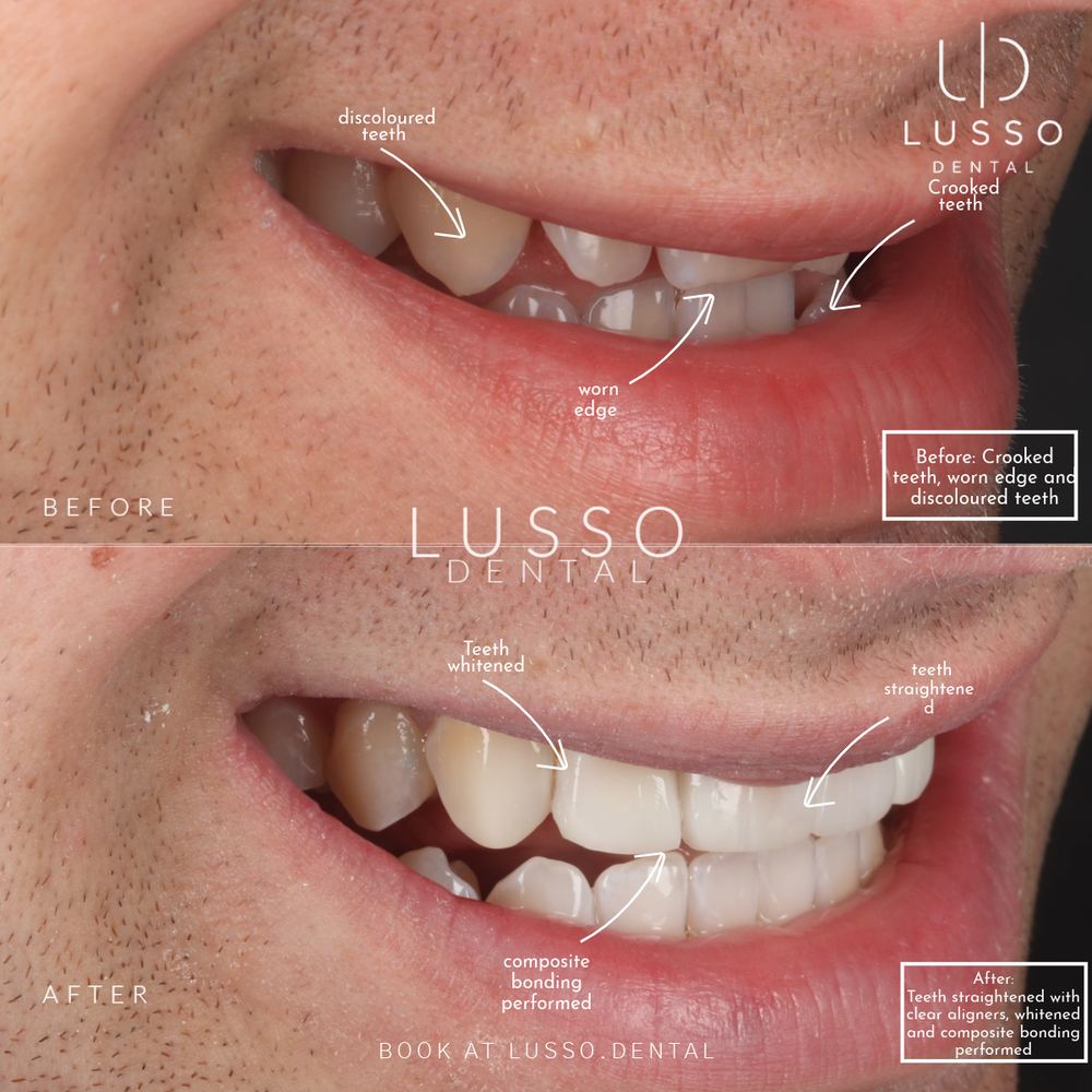 Clear aligners, before and after case 3 of 12, Dr Kal's own work