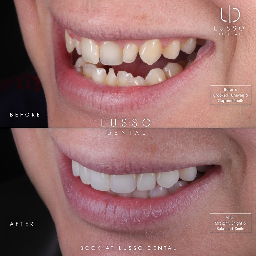 Clear aligners, before and after case 4 of 12, Dr Kal's own work