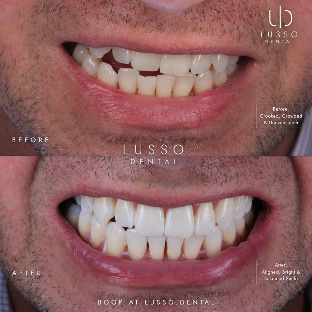 Clear aligners, before and after case 5 of 12, Dr Kal's own work