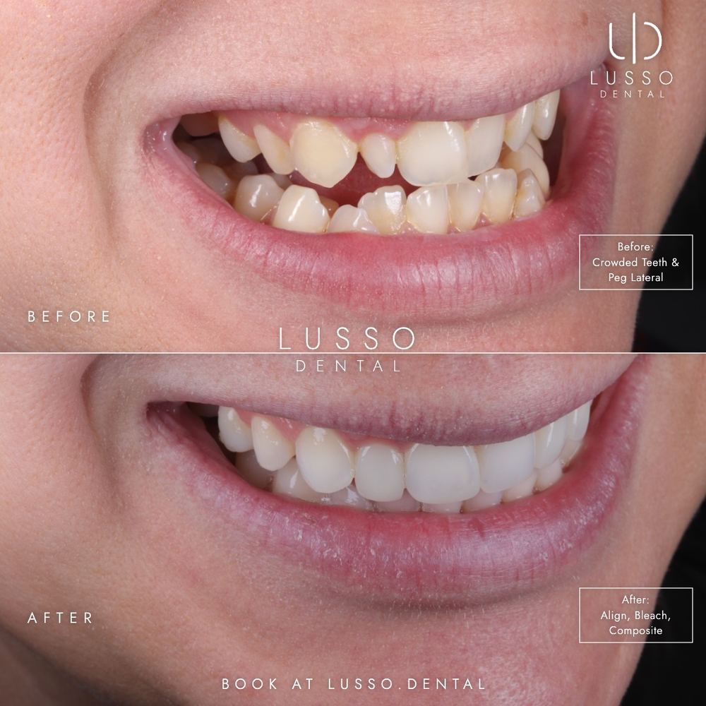 Clear aligners, before and after case 6 of 12, Dr Kal's own work