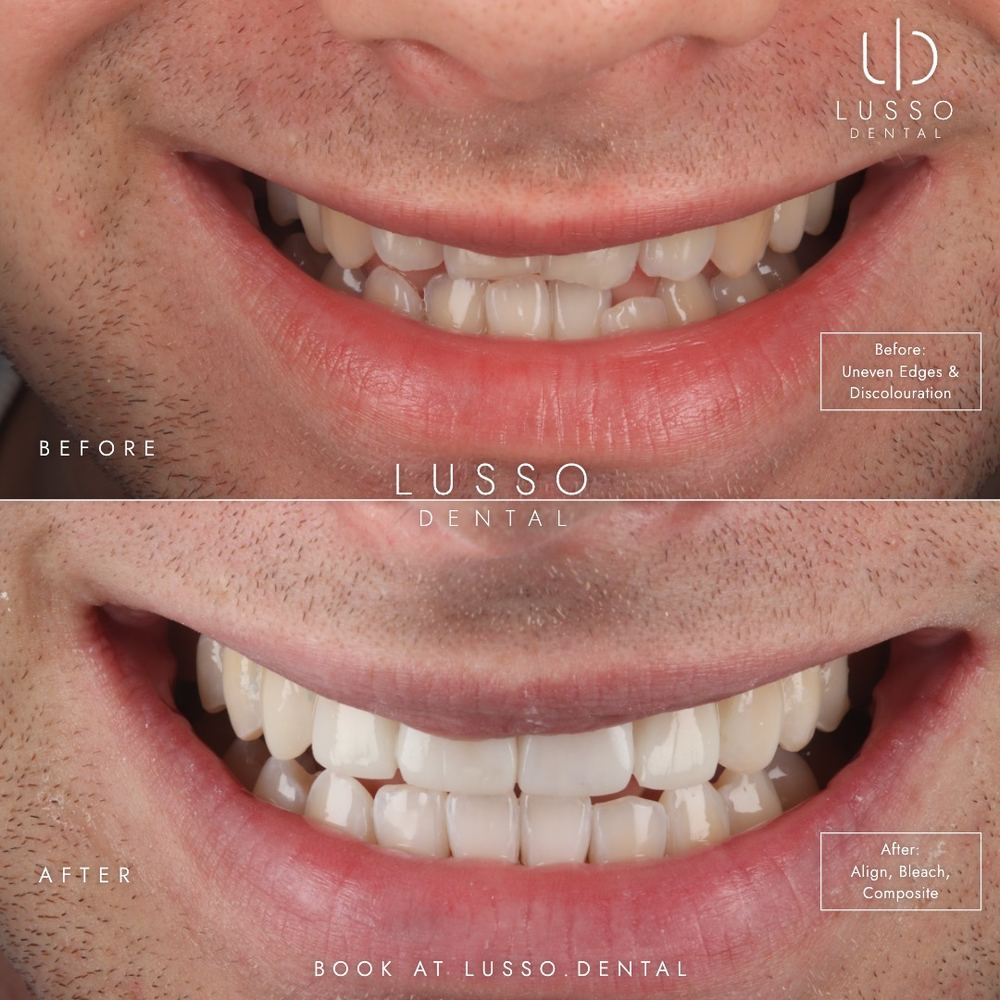 Clear aligners, before and after case 7 of 12, Dr Kal's own work
