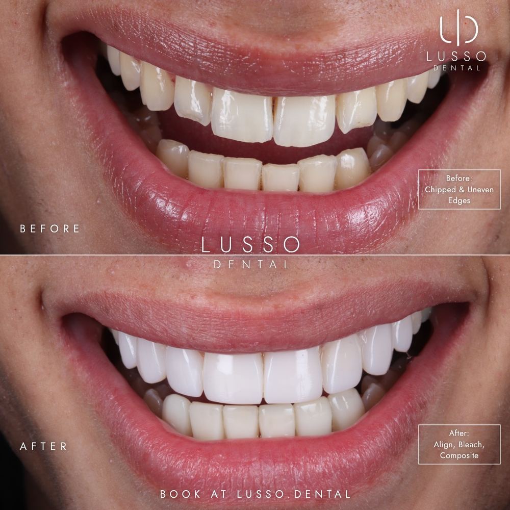 Clear aligners, before and after case 8 of 12, Dr Kal's own work