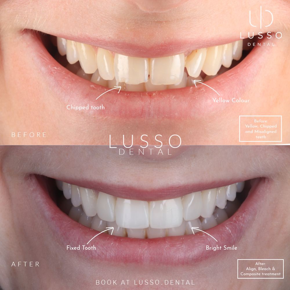 Clear aligners, before and after case 9 of 12, Dr Kal's own work
