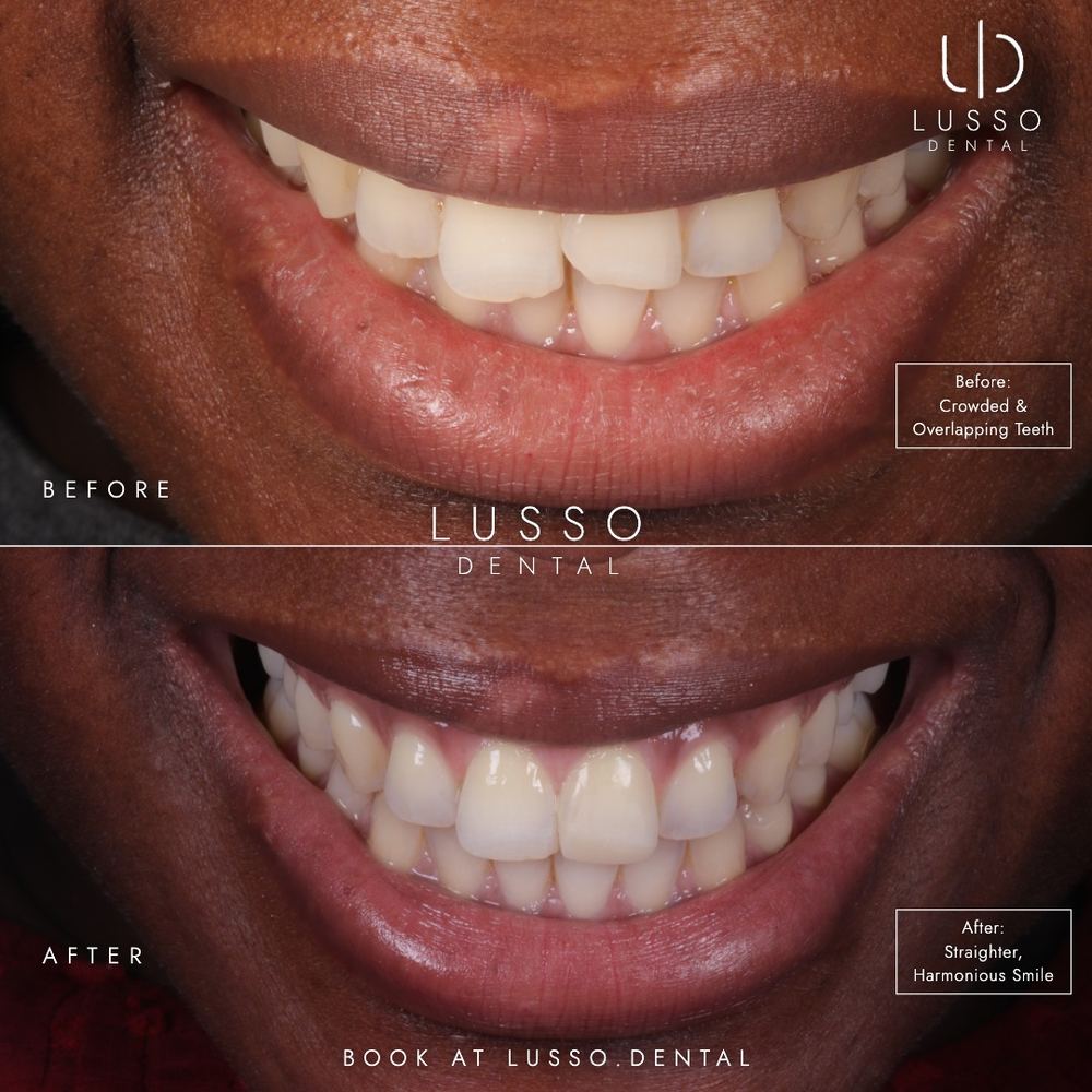 Clear aligners, before and after case 10 of 12, Dr Kal's own work