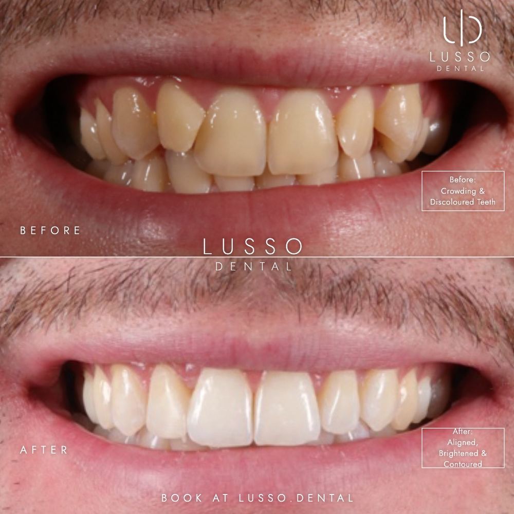 Clear aligners, before and after case 11 of 12, Dr Kal's own work