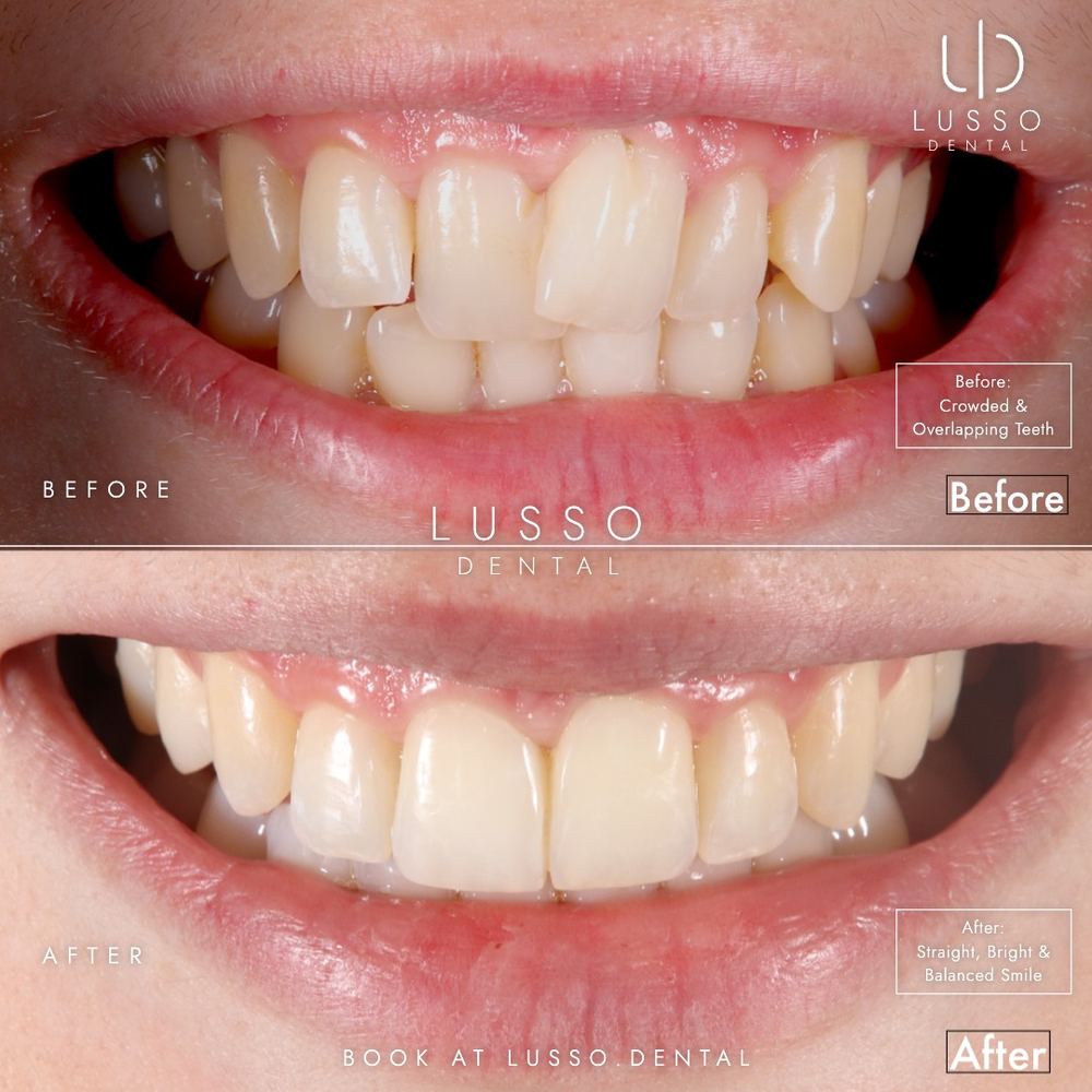 Clear aligners, before and after case 12 of 12, Dr Kal's own work