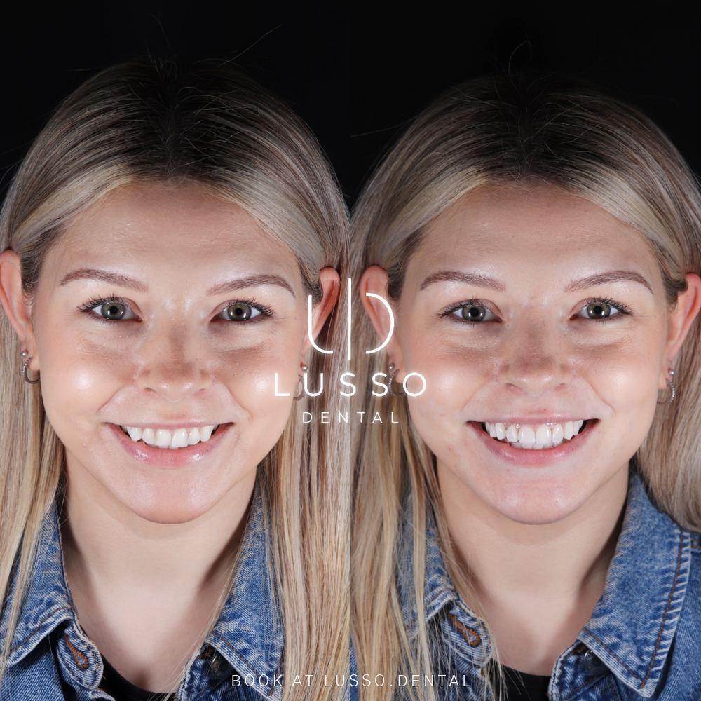 Composite bonding, before and after case 1, Dr Kal's own work