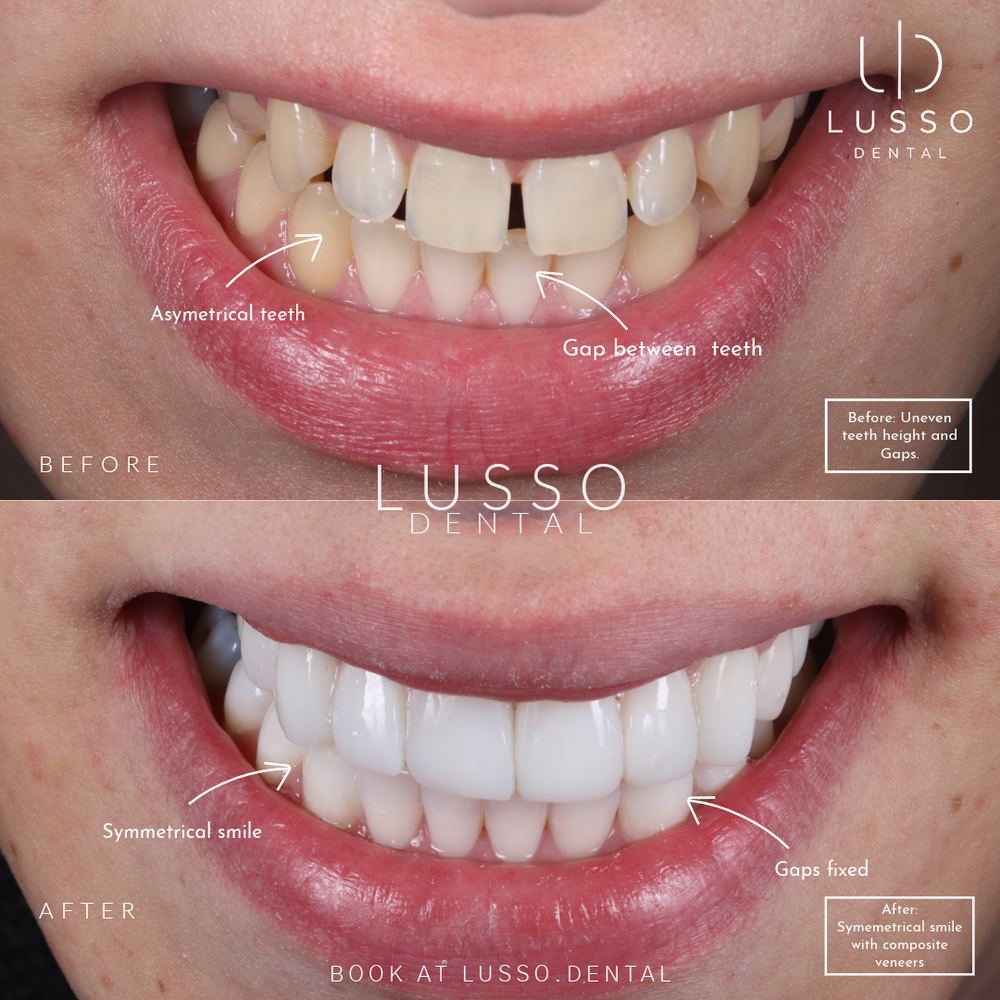 Composite bonding, before and after case 2, Dr Kal's own work