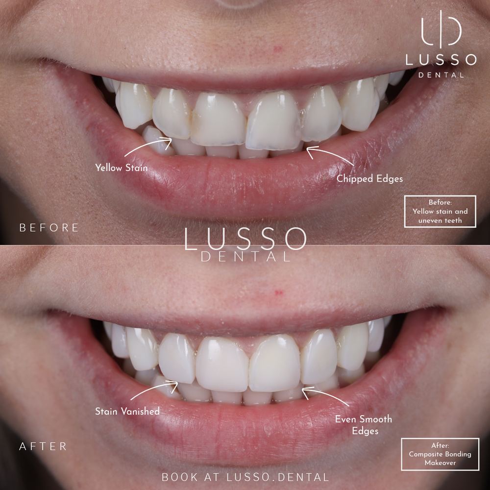 Composite bonding, before and after case 3, Dr Kal's own work