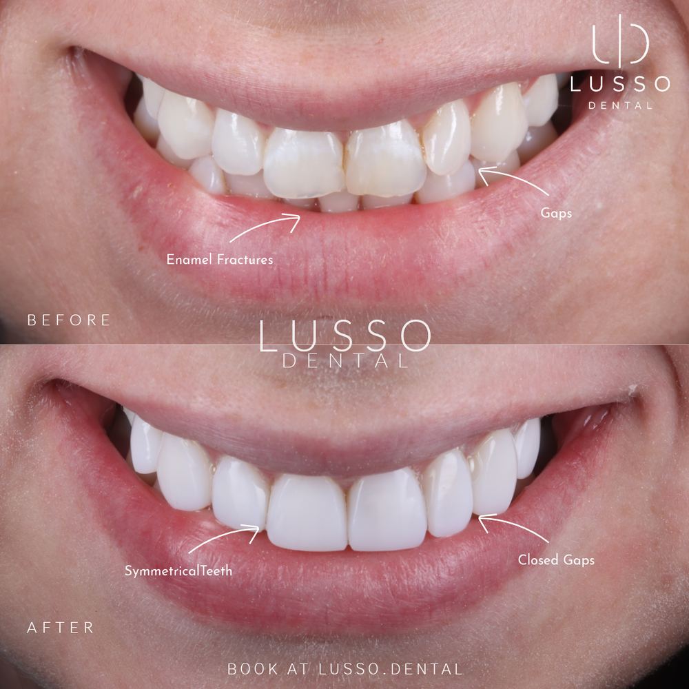 Composite bonding, before and after case 4, Dr Kal's own work
