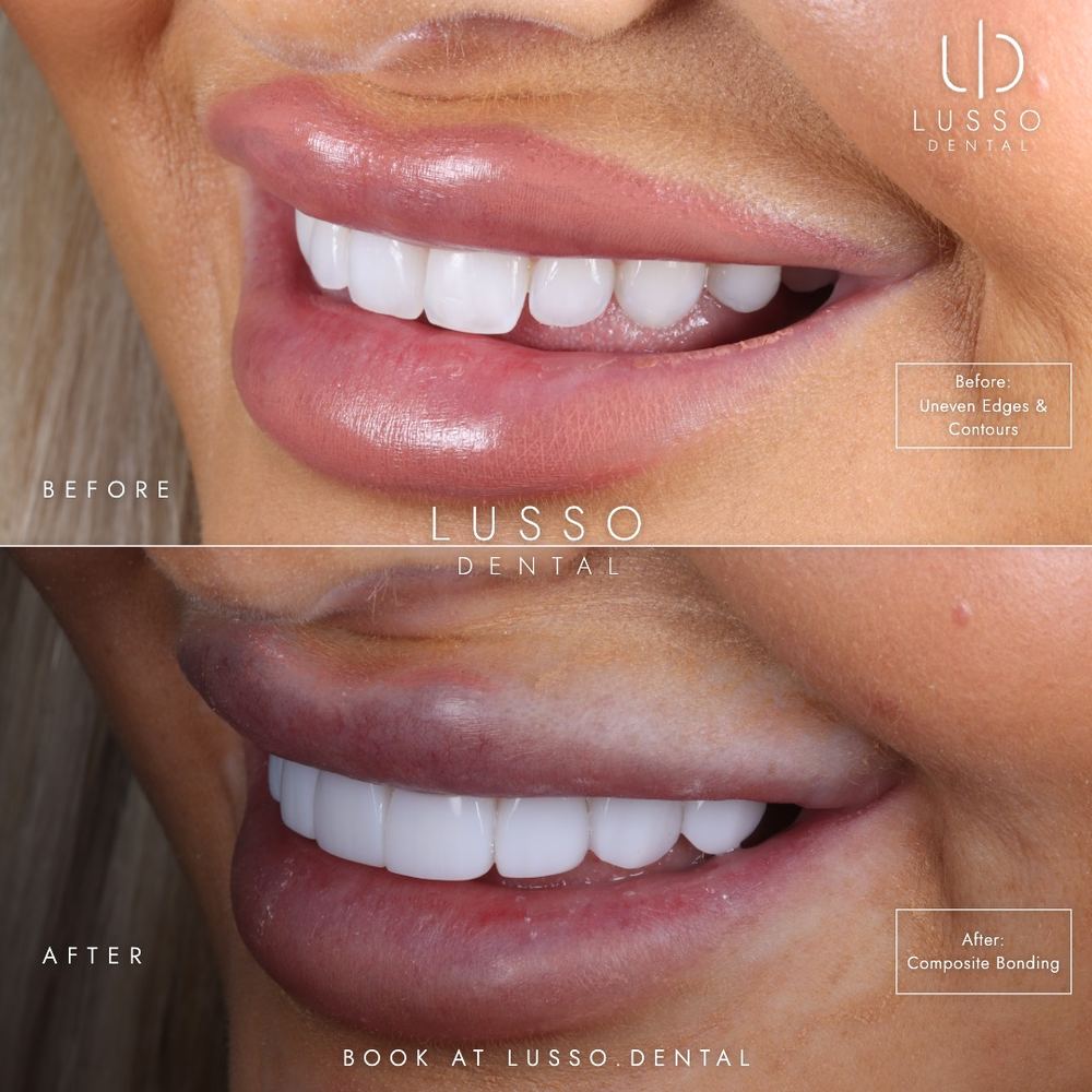 Composite bonding, before and after case 5, Dr Kal's own work