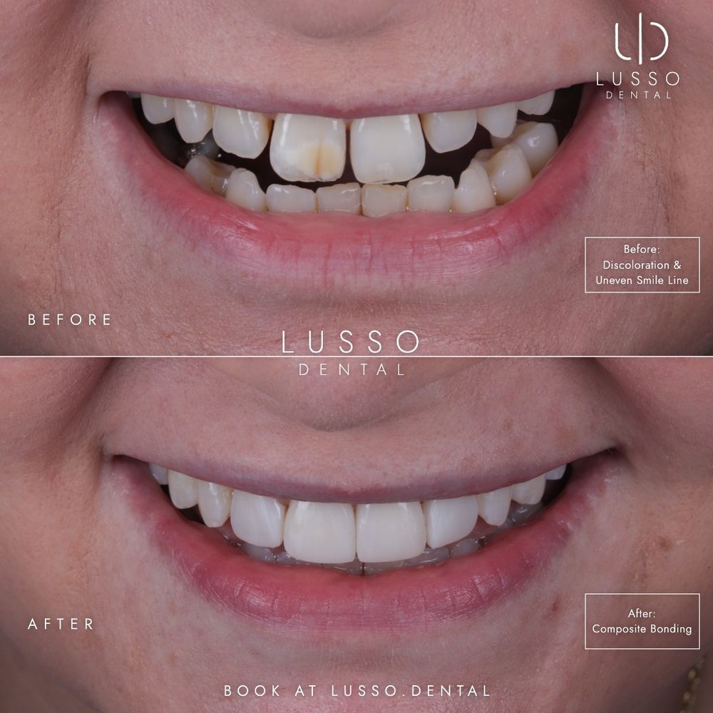 Composite bonding, before and after case 6, Dr Kal's own work
