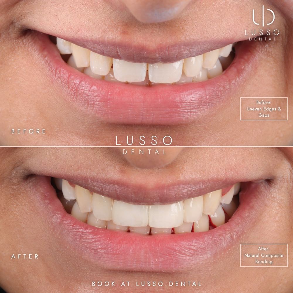 Composite bonding, before and after case 7, Dr Kal's own work