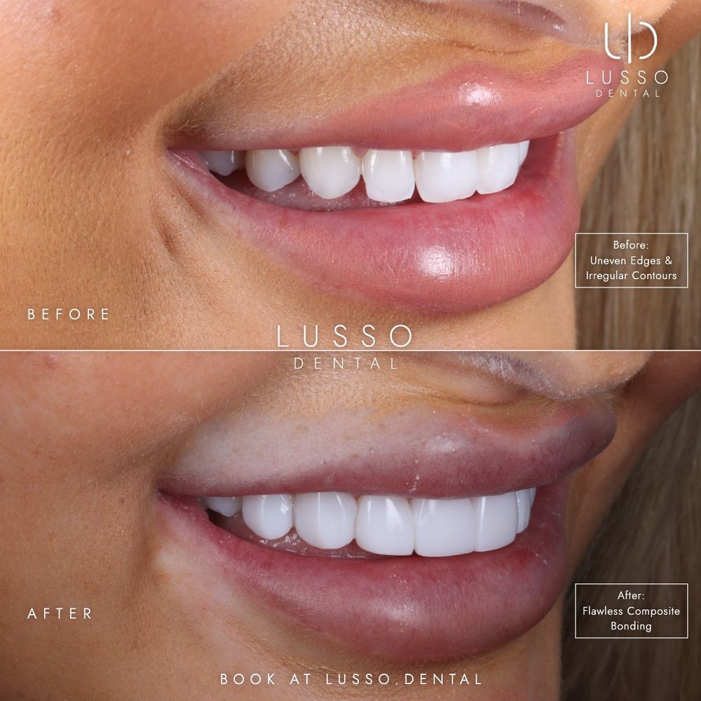 Composite bonding, before and after case 8, Dr Kal's own work