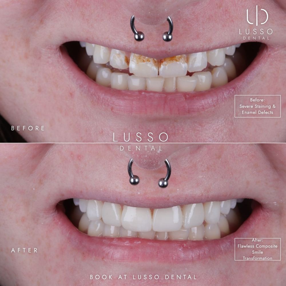 Composite bonding, before and after case 9, Dr Kal's own work