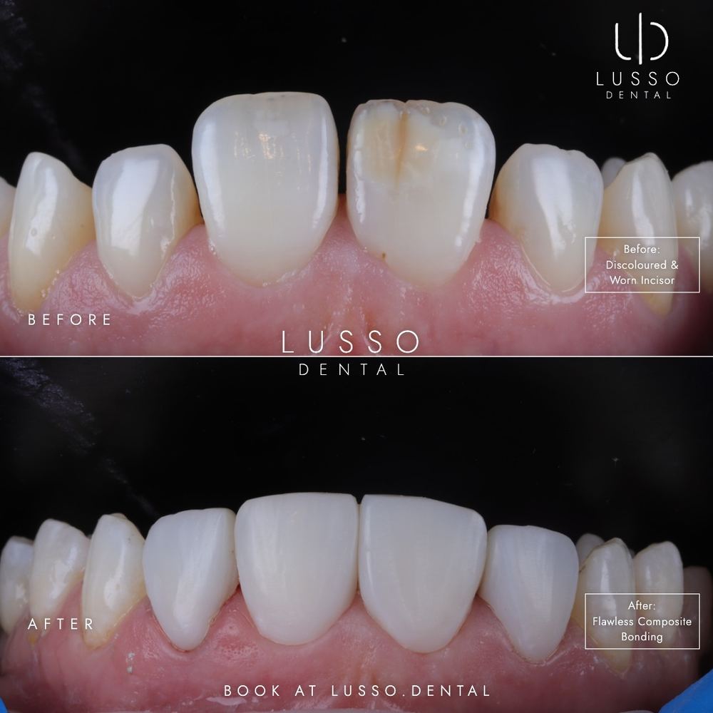 Composite bonding, before and after case 10, Dr Kal's own work