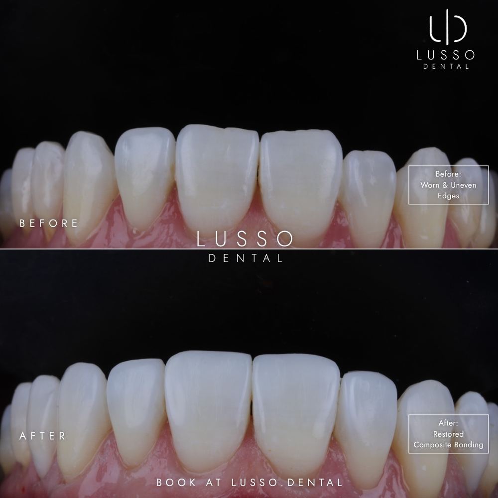 Composite bonding, before and after case 11, Dr Kal's own work