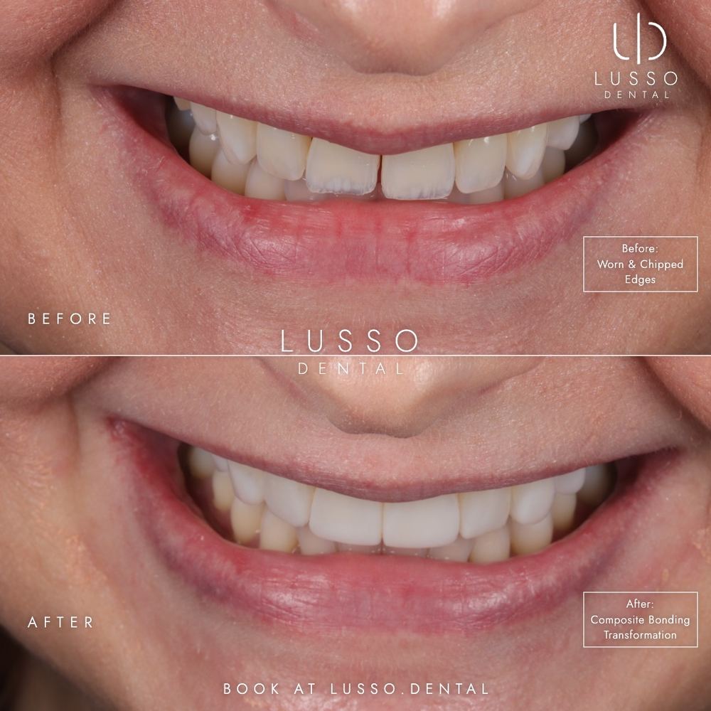 Composite bonding, before and after case 12, Dr Kal's own work