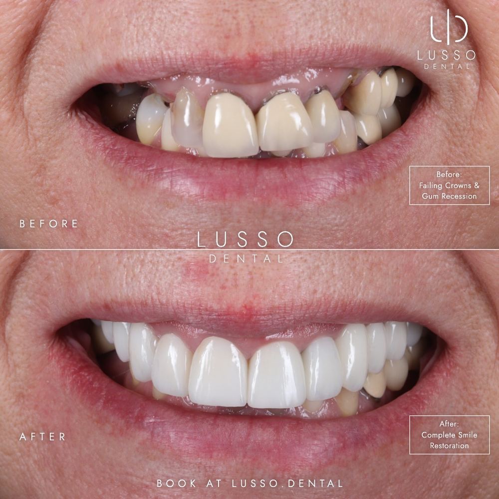 Crowns and bridges, before and after case 2, Dr Kal's own work