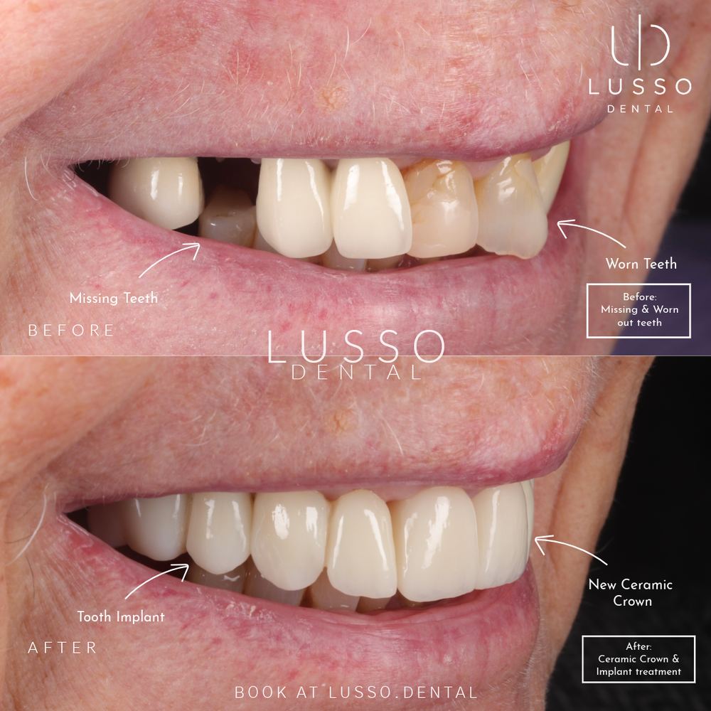 Crowns and bridges, before and after case 3, Dr Kal's own work