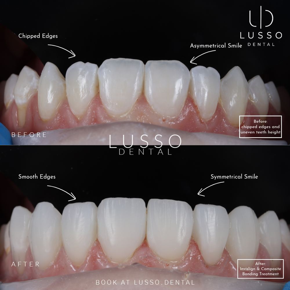 Edge bonding, before and after case 1 of 8, Dr Kal's own work