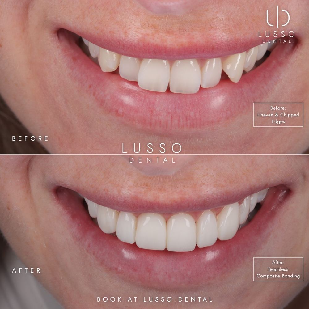 Edge bonding, before and after case 3 of 8, Dr Kal's own work