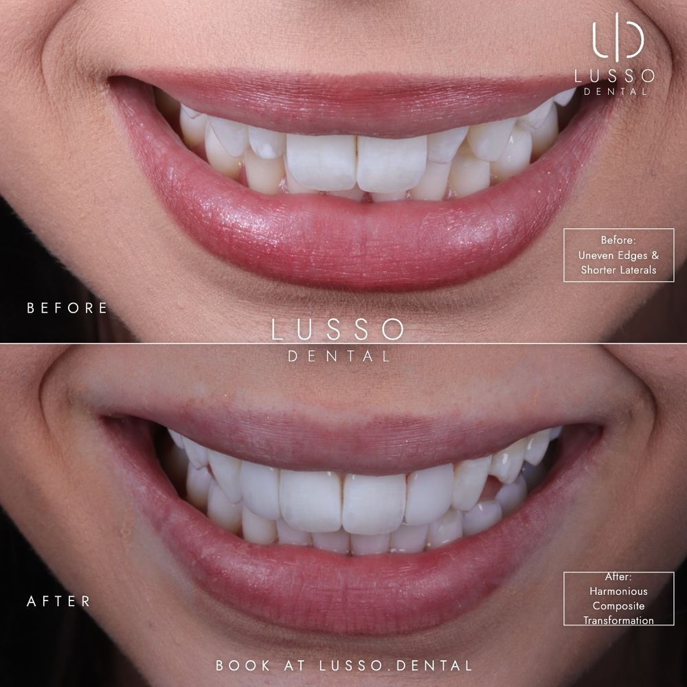 Edge bonding, before and after case 4 of 8, Dr Kal's own work