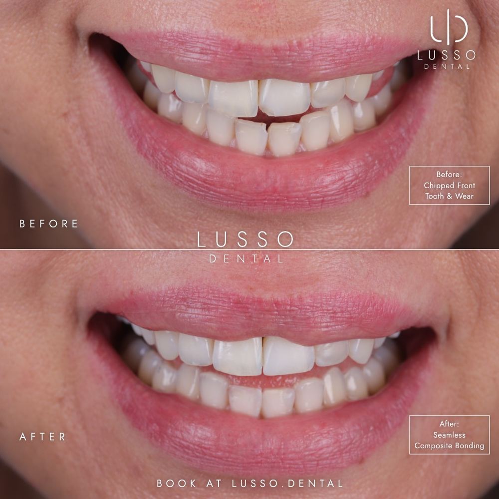 Edge bonding, before and after case 5 of 8, Dr Kal's own work