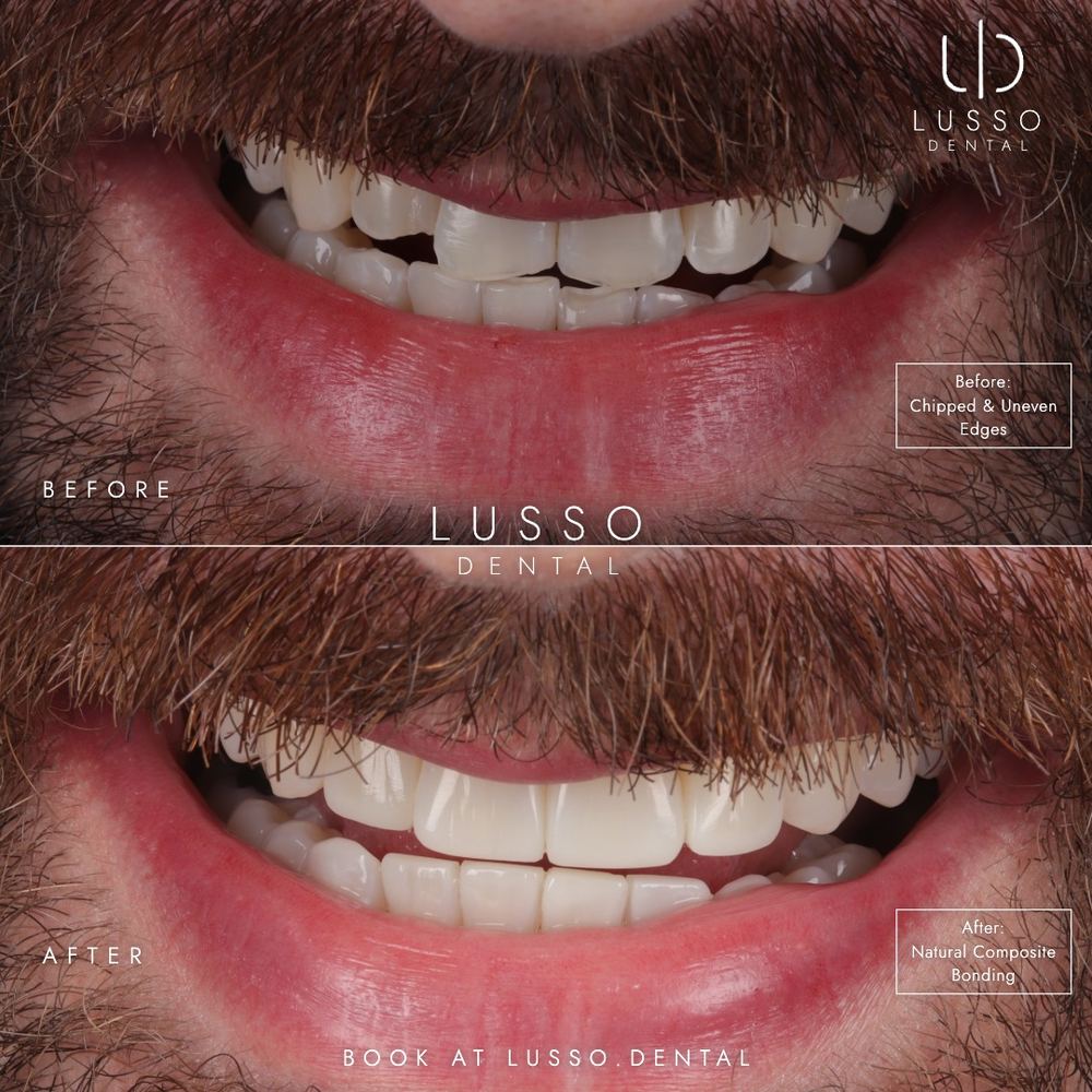 Edge bonding, before and after case 6 of 8, Dr Kal's own work
