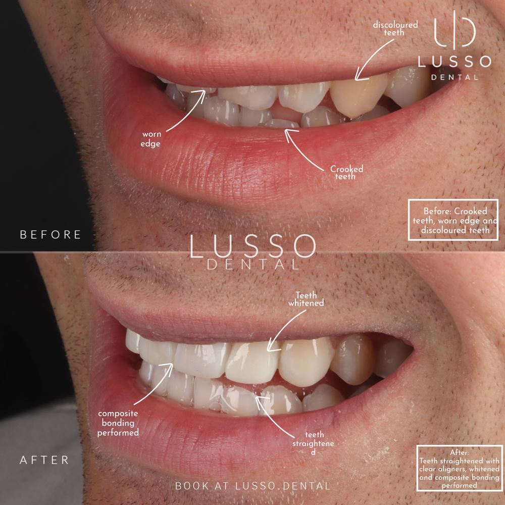 Edge bonding, before and after case 7 of 8, Dr Kal's own work