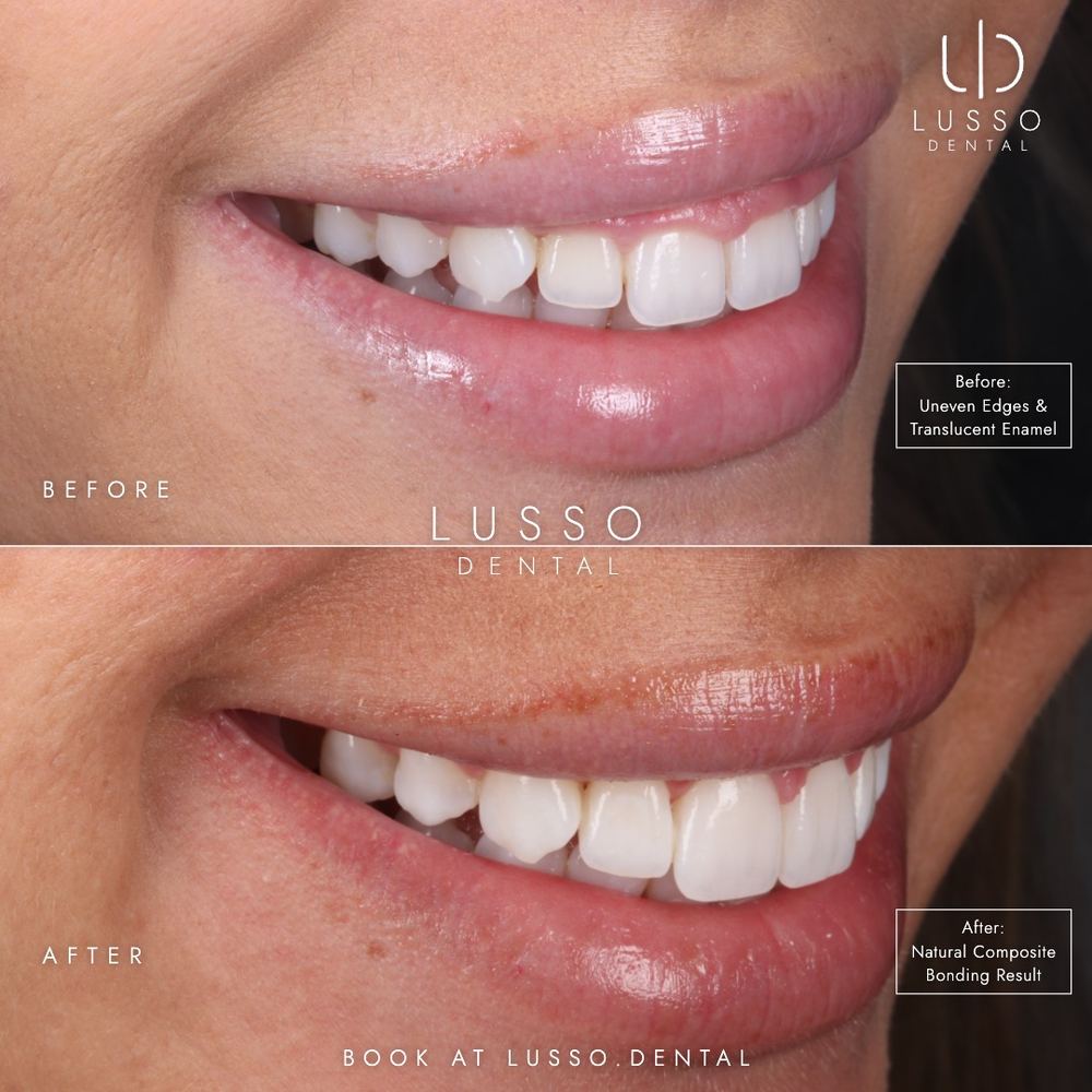 Edge bonding, before and after case 8 of 8, Dr Kal's own work