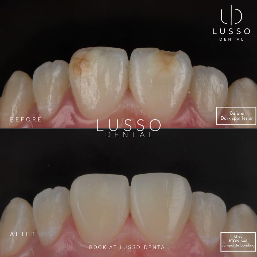 ICON white spot removal, before and after case 2, Dr Kal's own work