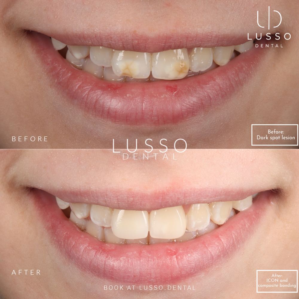 ICON white spot removal, before and after case 3, Dr Kal's own work