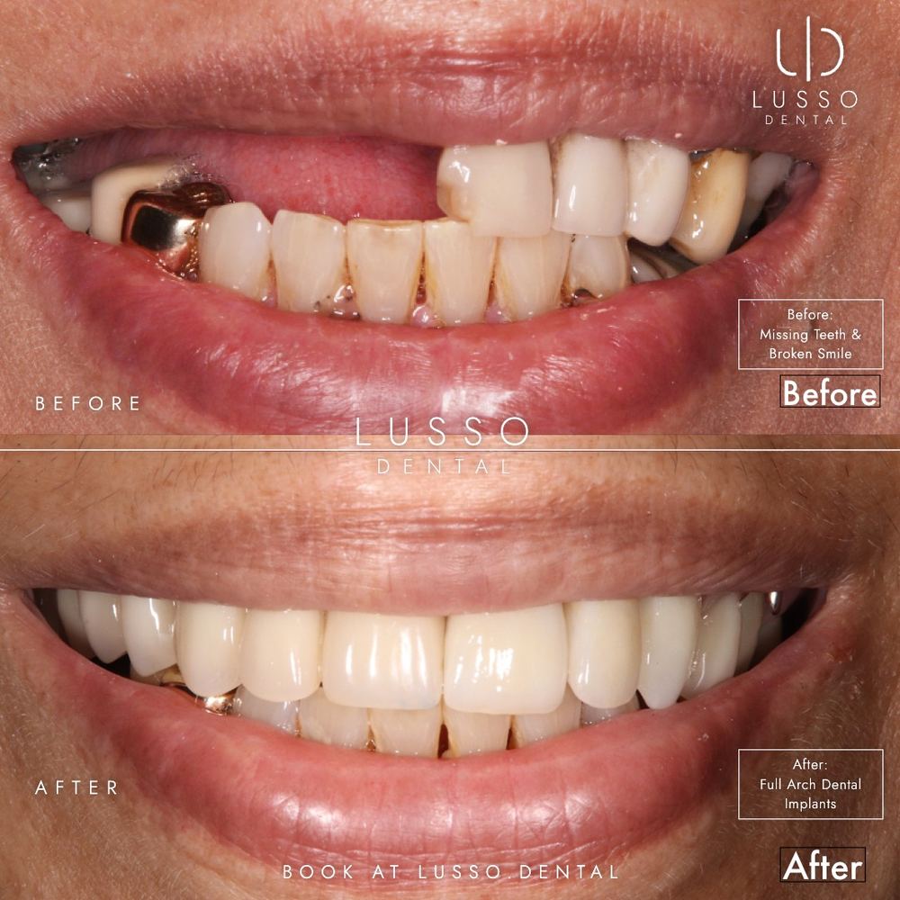 Dental implants, before and after case 2, Dr Kal's own work