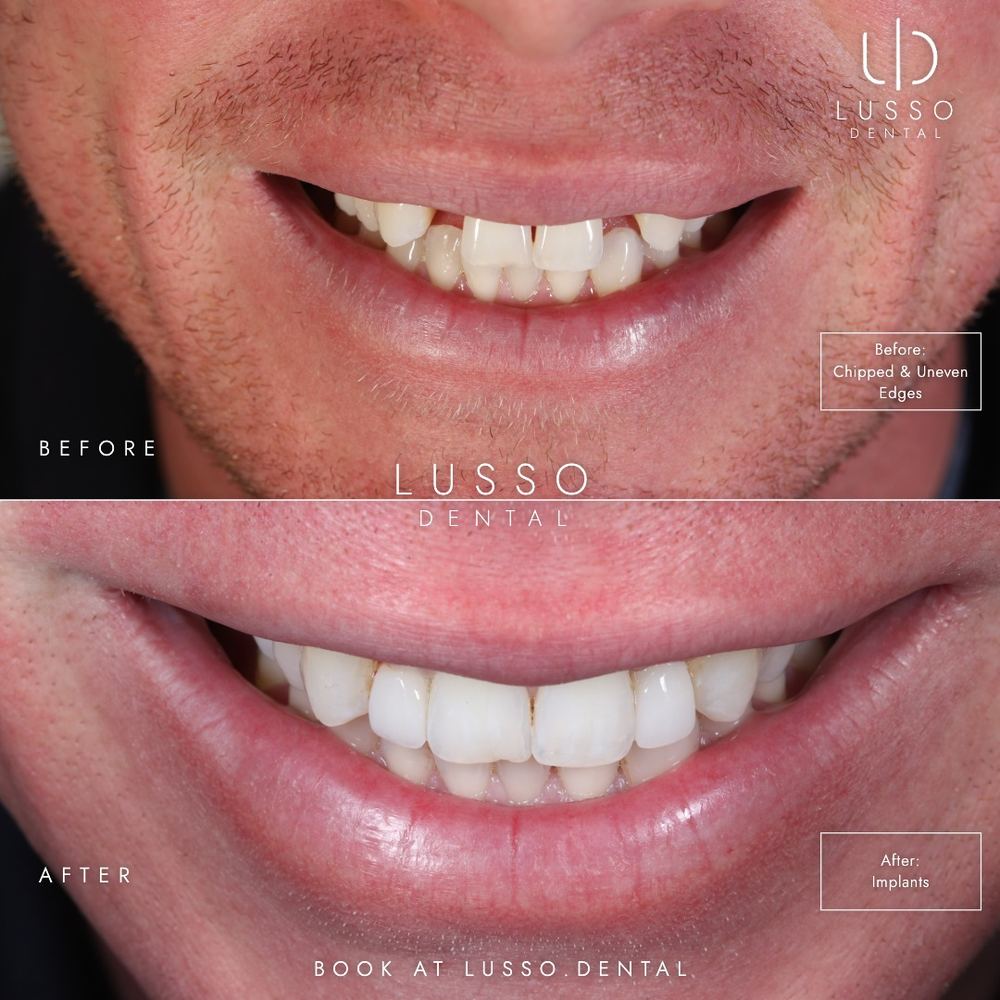 Dental implants, before and after case 3, Dr Kal's own work