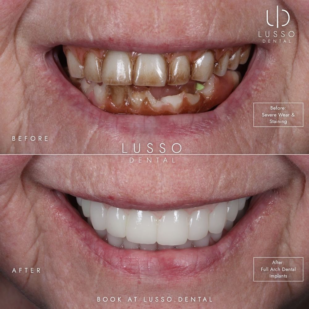 Dental implants, before and after case 5, Dr Kal's own work