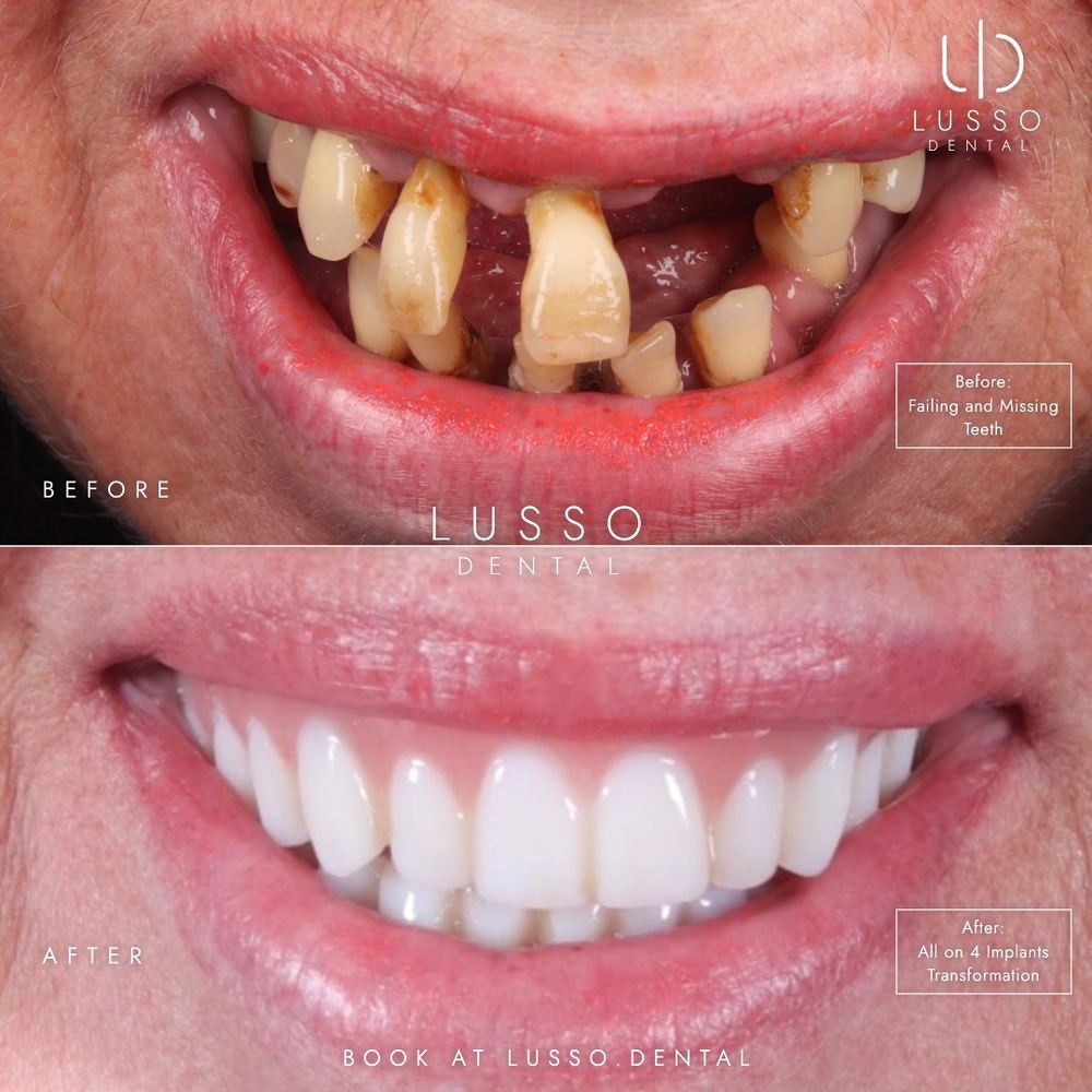 Dental implants, before and after case 6, Dr Kal's own work