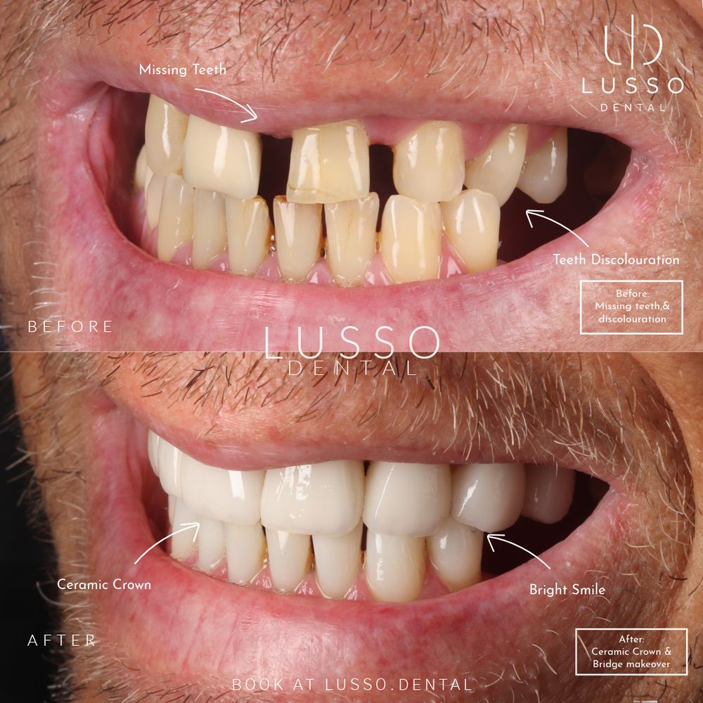 Dental implants, before and after case 7, Dr Kal's own work
