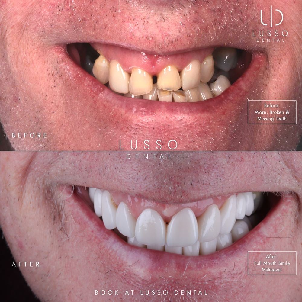 Smile makeovers, before and after case 6, Dr Kal's own work