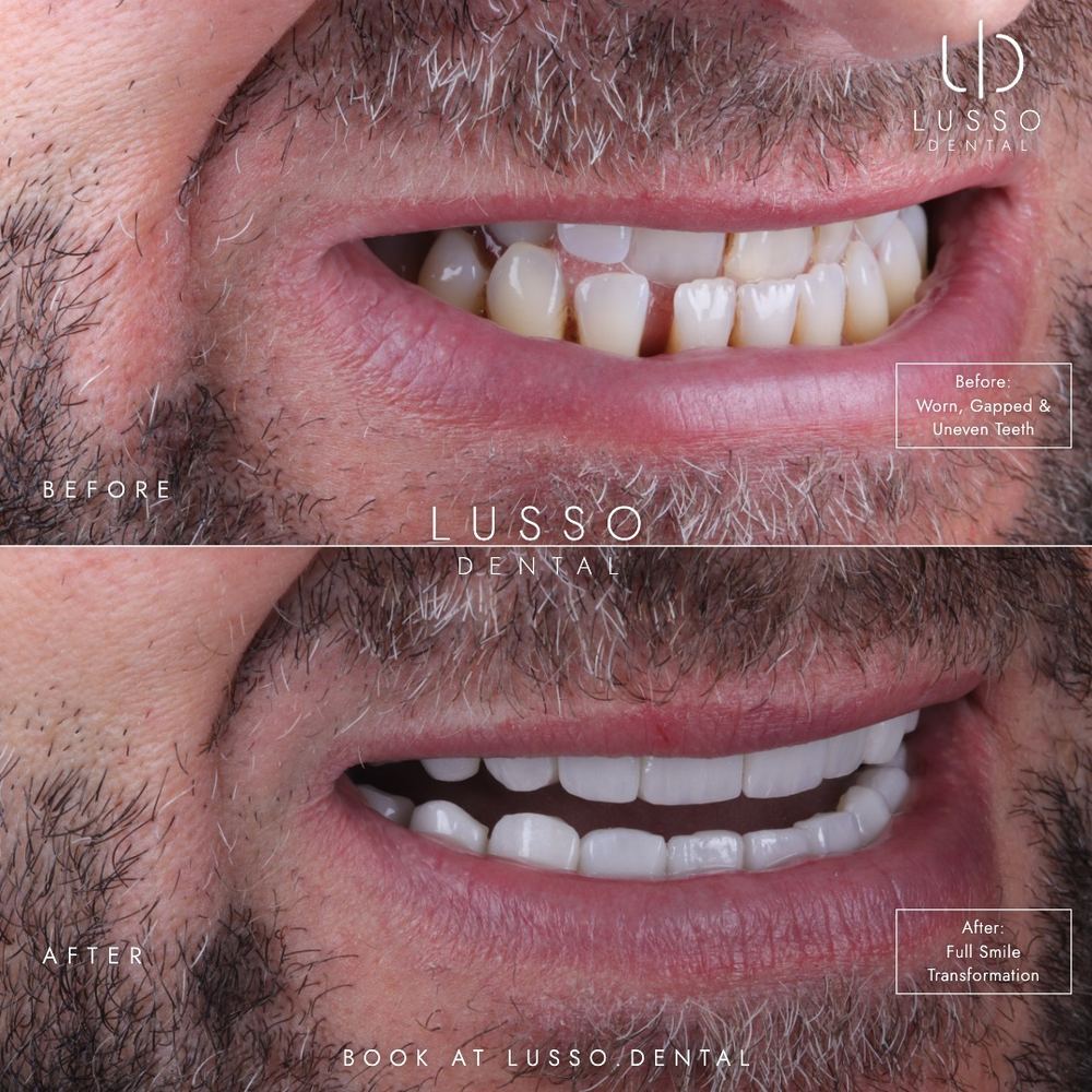 Smile makeovers, before and after case 7, Dr Kal's own work