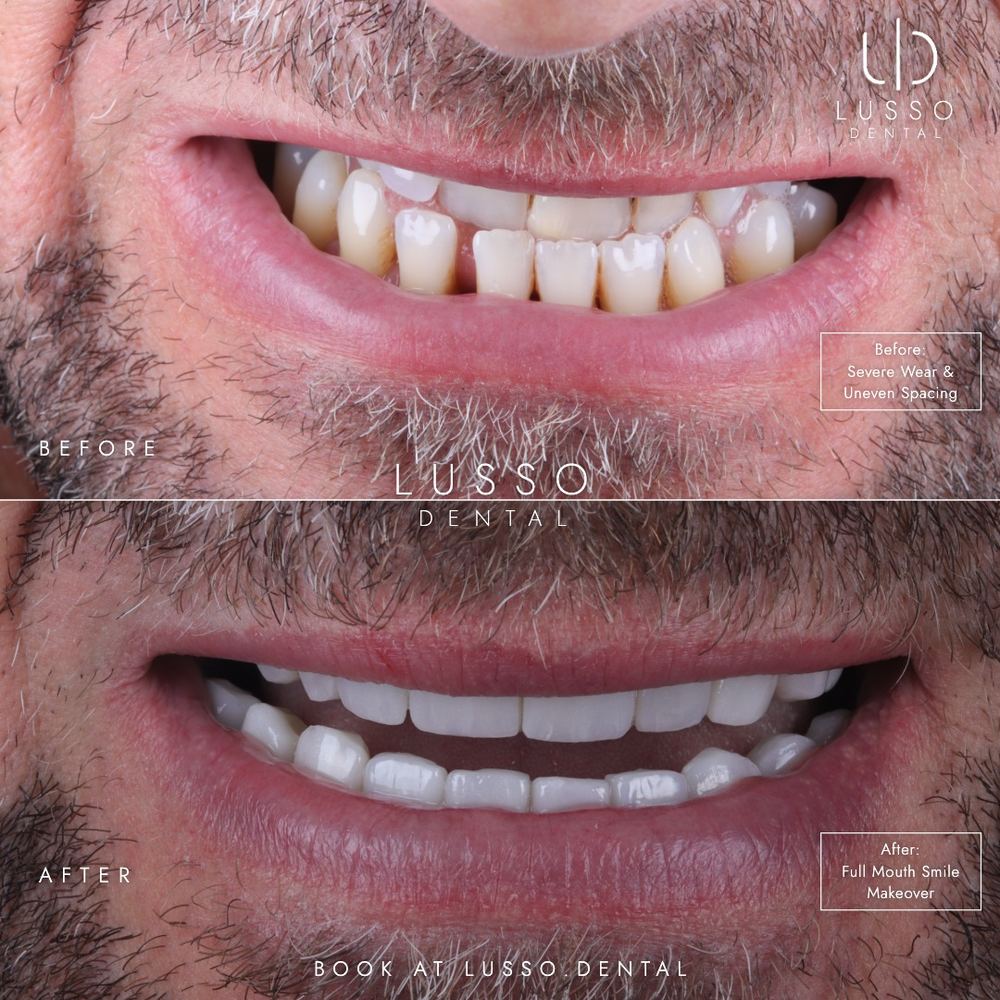 Smile makeovers, before and after case 8, Dr Kal's own work