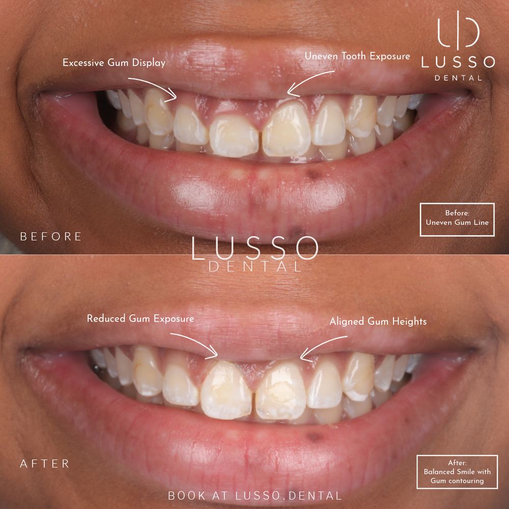 Smile makeovers, before and after case 9, Dr Kal's own work