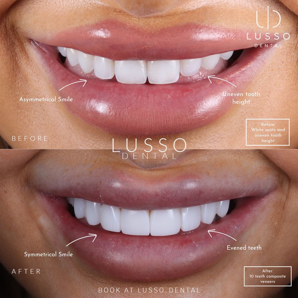 Smile makeovers, before and after case 10, Dr Kal's own work