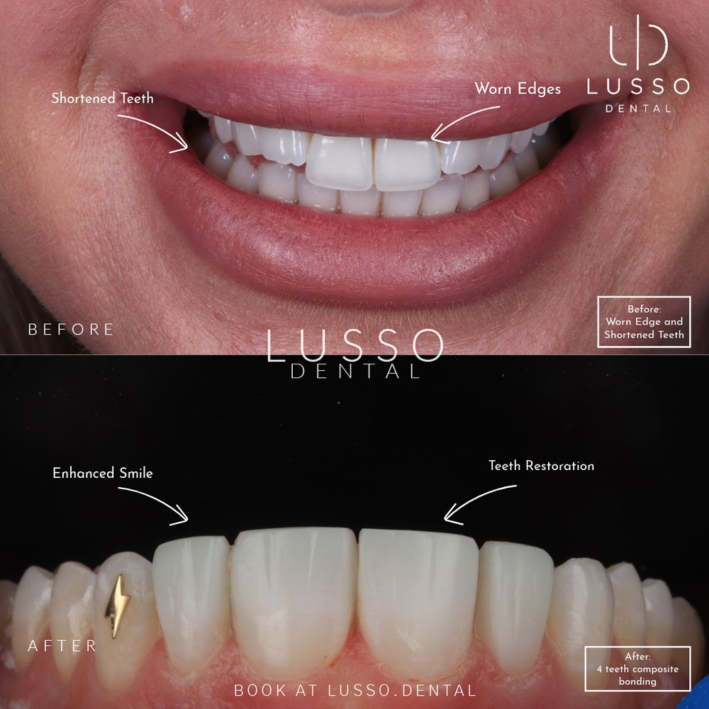 Smile makeovers, before and after case 11, Dr Kal's own work