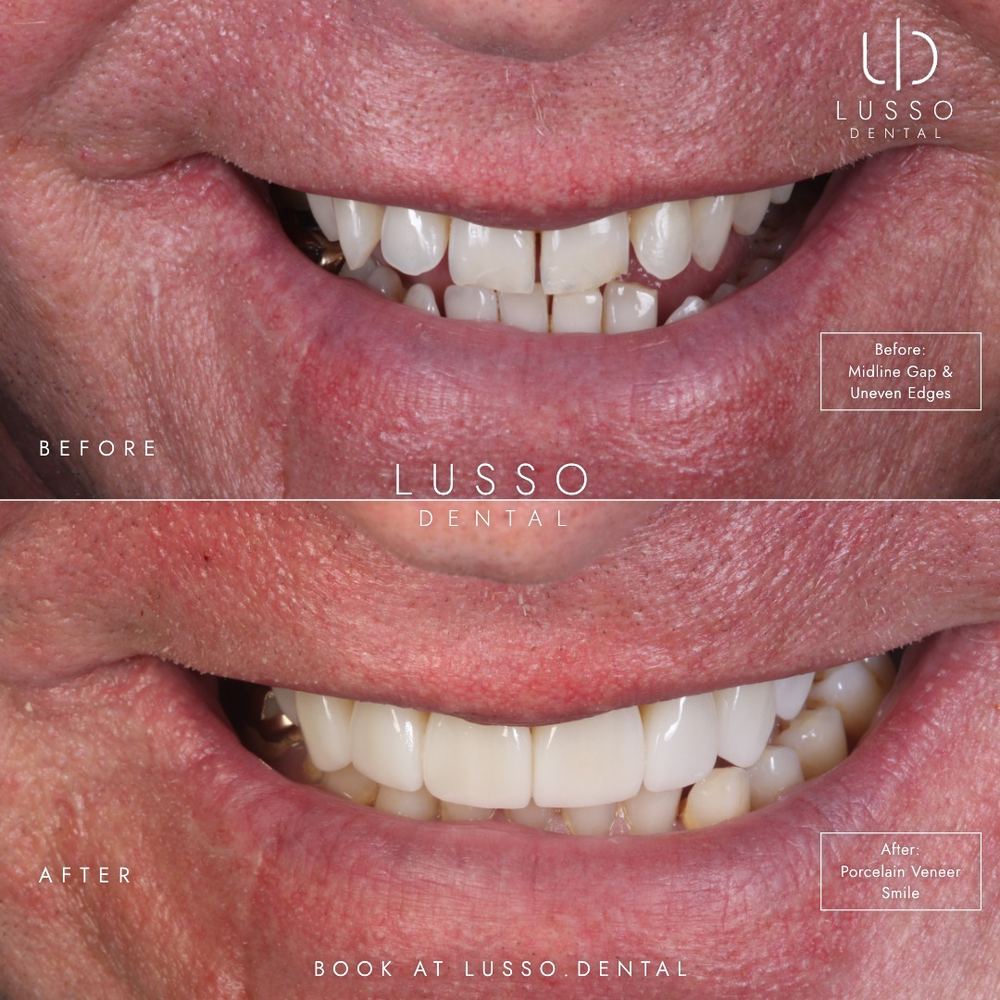 Smile makeovers, before and after case 12, Dr Kal's own work