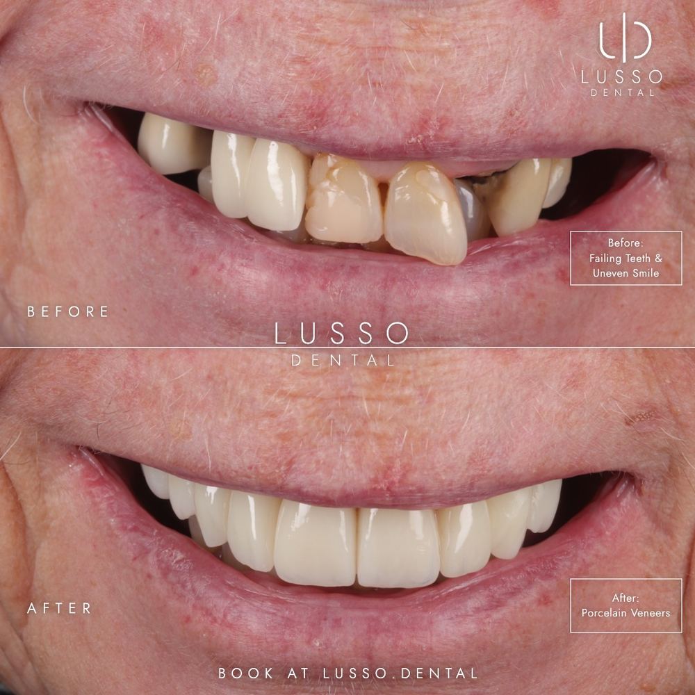 Porcelain veneers, before and after case 3, Dr Kal's own work