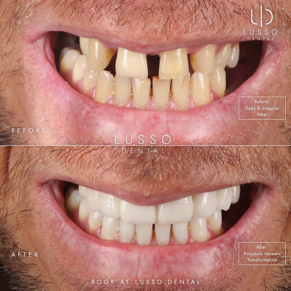 Porcelain veneers, before and after case 4, Dr Kal's own work